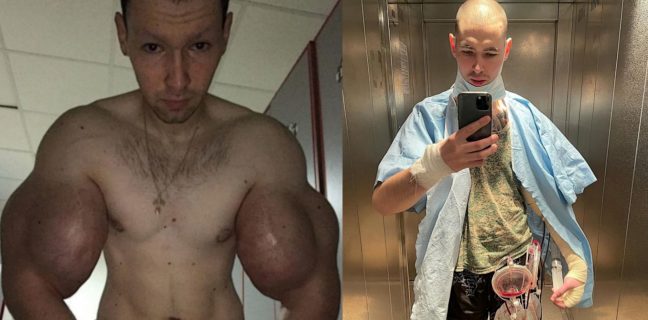 Viciado em Synthol, Kirill Tereshin está hospitalizado e tem fluidos drenados de seus braços