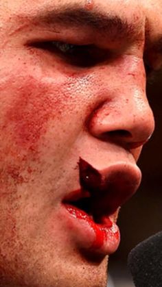 Robbie Lawler split lip -worst faces