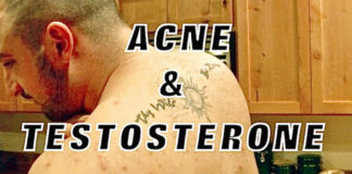 Testosterone Acne Generation Iron