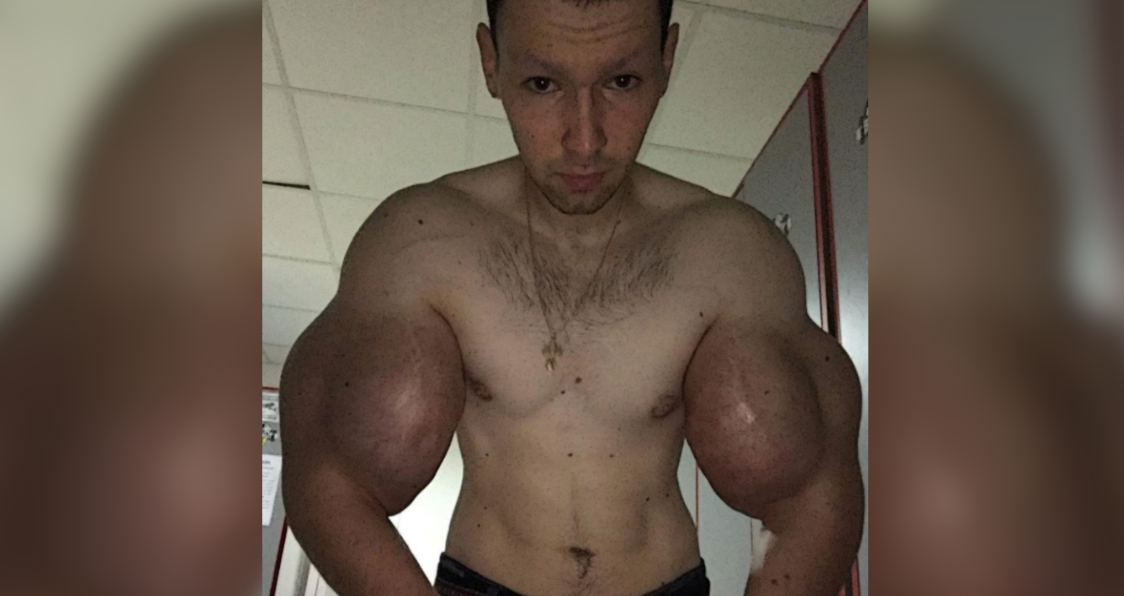 Synthol Addict Kirill Tereshin Has 3 Pounds of 'Dead' Muscle Removed From  Arms