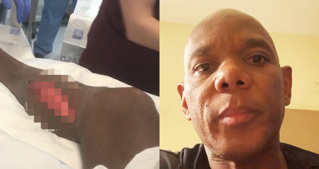 Flex Wheeler Leg Amputation Generation Iron