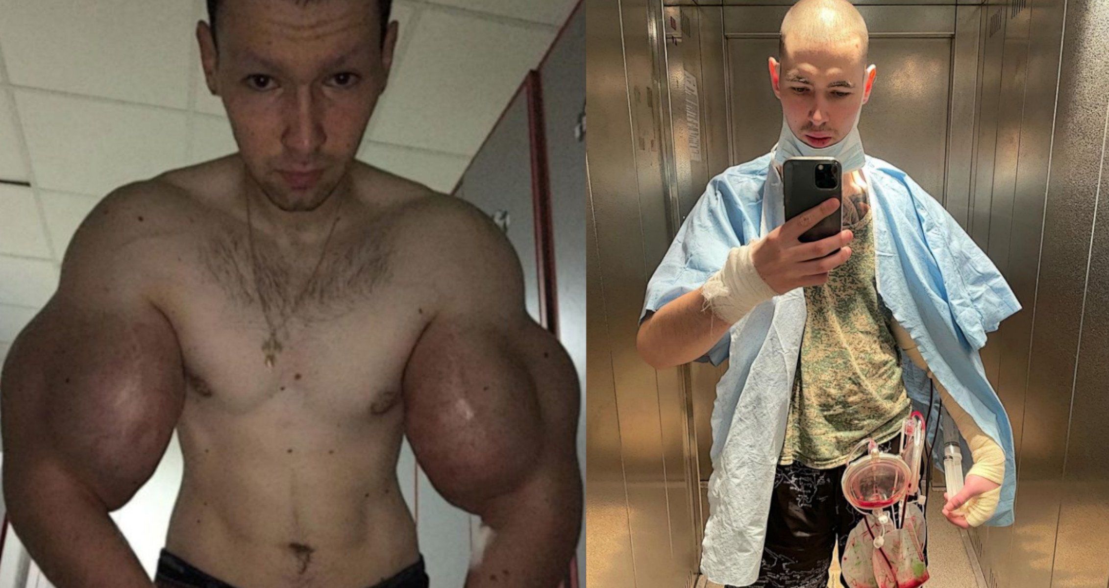 Synthol Addict Kirill Tereshin Hospitalized Gets Fluid Drained From His Arms