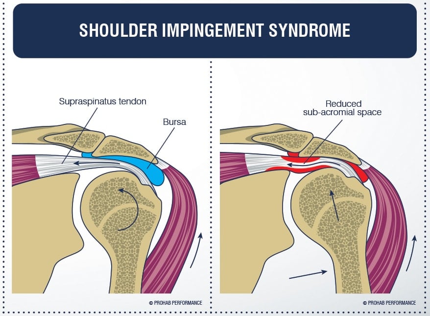 Shoulder pain impingement