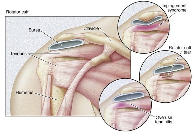 Rotator cuff tear