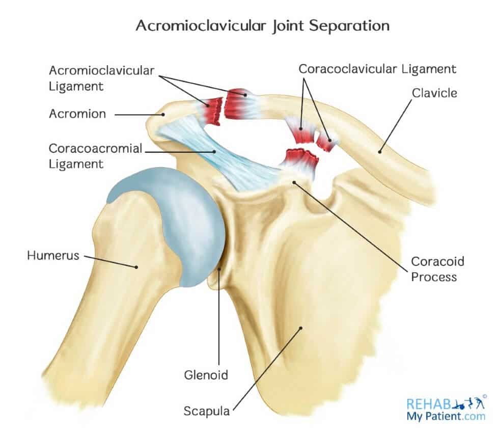 Ac joint separation