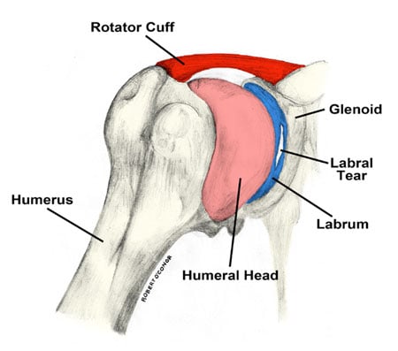 Labrum tear