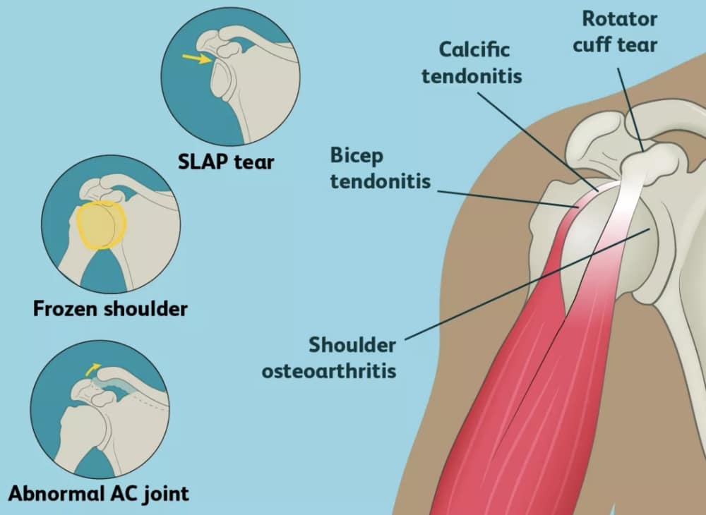 Shoulder injury causes
