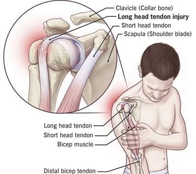 Bicep Tendonitis Shoulder pain