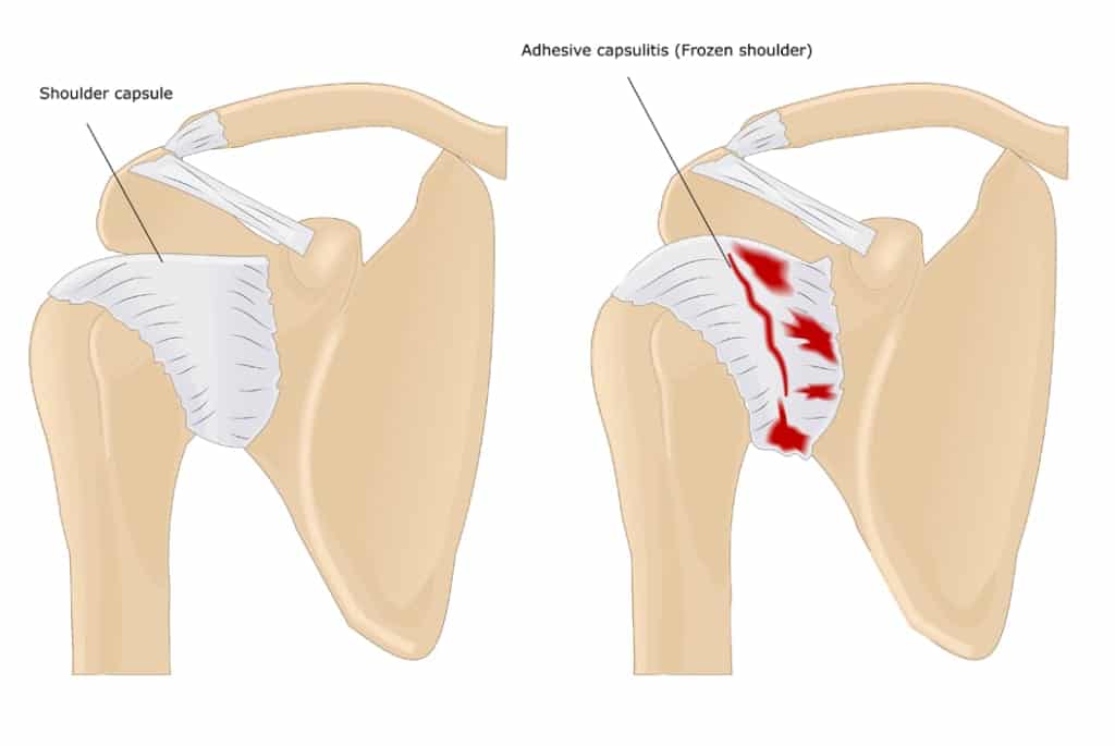 Frozen shoulder 