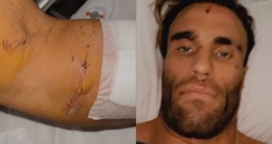Calum Von Moger bodybuilder accident
