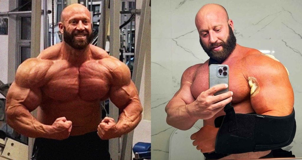 Petar Klancir bodybuilder surgery