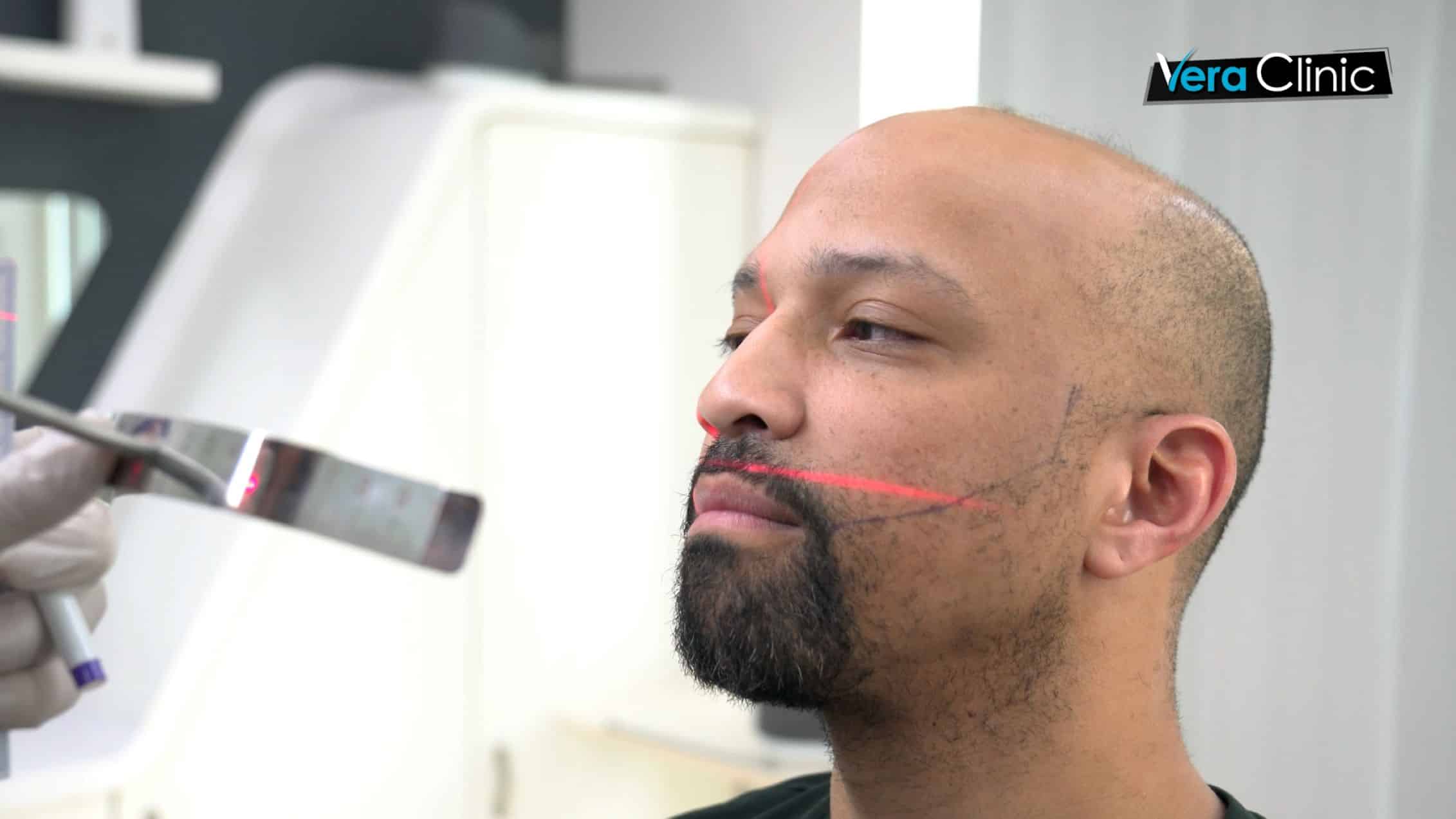 Scalp Micropigmentation