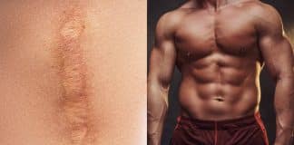 bodybuilding scar