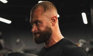 Chris Bumstead Hair Transplant