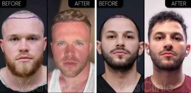 hair transplant before and after
