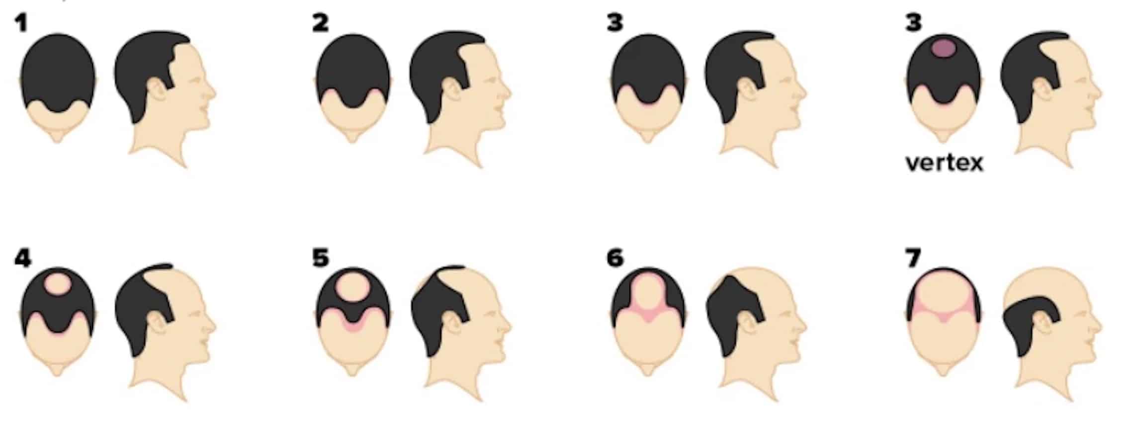stages of a hair transplant