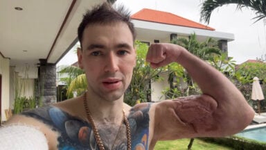 Russian ‘Popeye’ Kirill Tereshin Shares Status After Operation To Drain Biceps